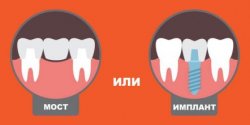 Протезирование зубов в Днепре