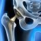 Infusion of bone metal on the durability of endoprostheses for orthopedic operations