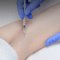 Гипергидроз: признаки и особенности лечения в ML Beauty Clinic