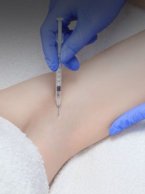 Гипергидроз: признаки и особенности лечения в ML Beauty Clinic