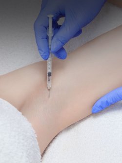 Гипергидроз: признаки и особенности лечения в ML Beauty Clinic